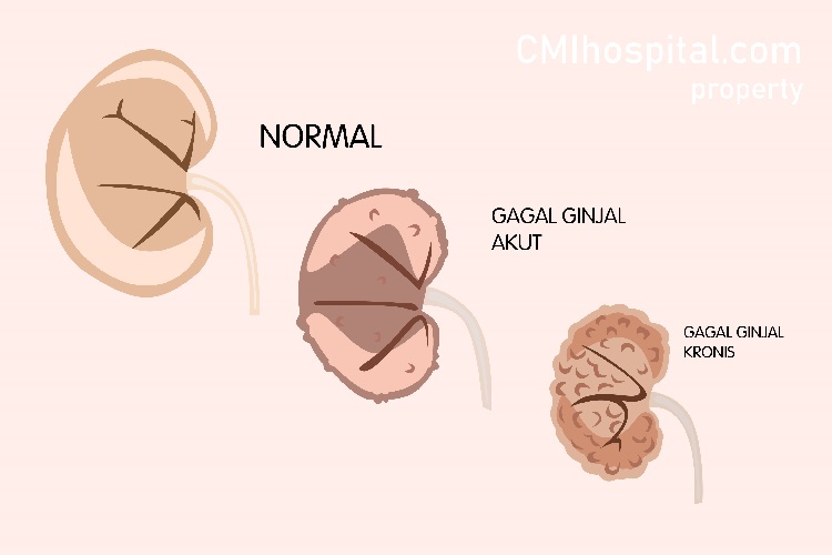 Detail Gambar Penyakit Ginjal Akut Nomer 5