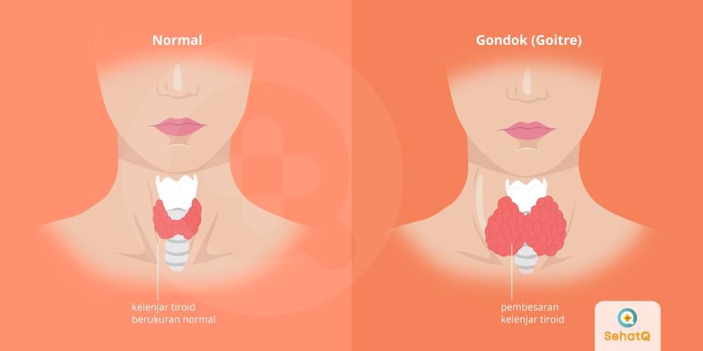 Gambar Penyakit Gondok - KibrisPDR