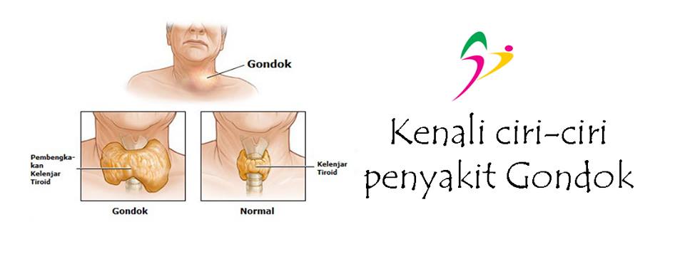 Detail Gambar Penyakit Gondok Nomer 8