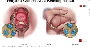 Detail Gambar Penyakit Gonore Nomer 5