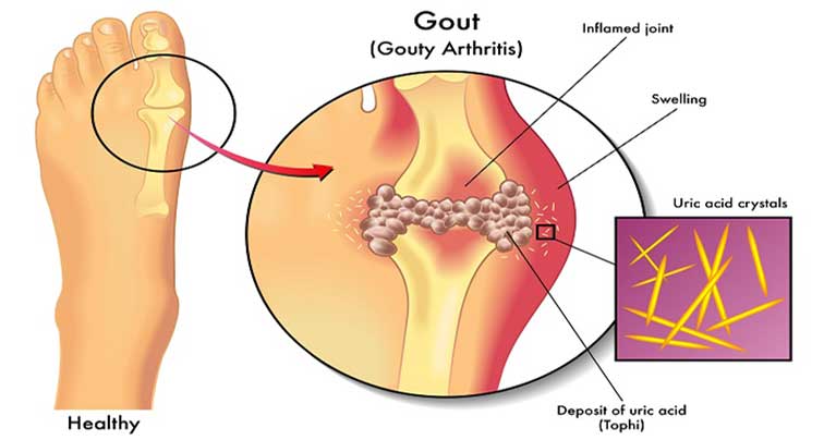 Gambar Penyakit Gout - KibrisPDR