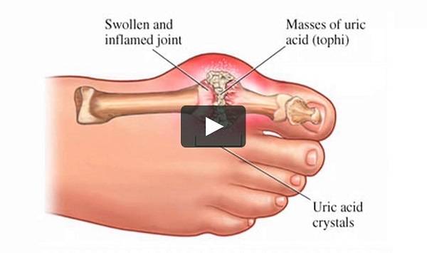 Detail Gambar Penyakit Gout Nomer 8