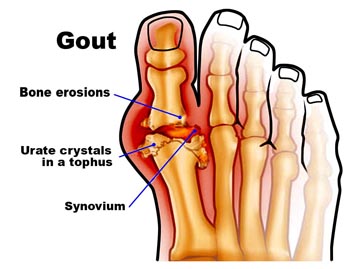 Detail Gambar Penyakit Gout Nomer 3