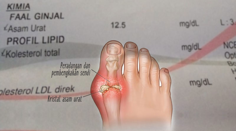 Detail Gambar Penyakit Gout Nomer 38