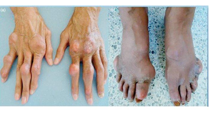 Detail Gambar Penyakit Gout Nomer 39