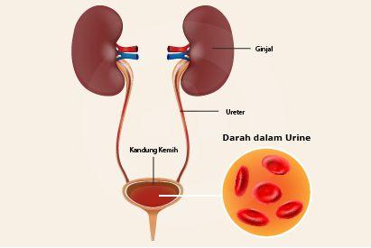 Gambar Penyakit Hematuria - KibrisPDR