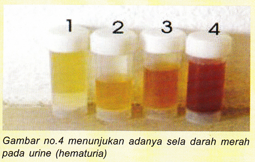 Detail Gambar Penyakit Hematuria Nomer 17