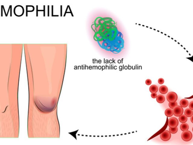 Detail Gambar Penyakit Hemofilia Nomer 2