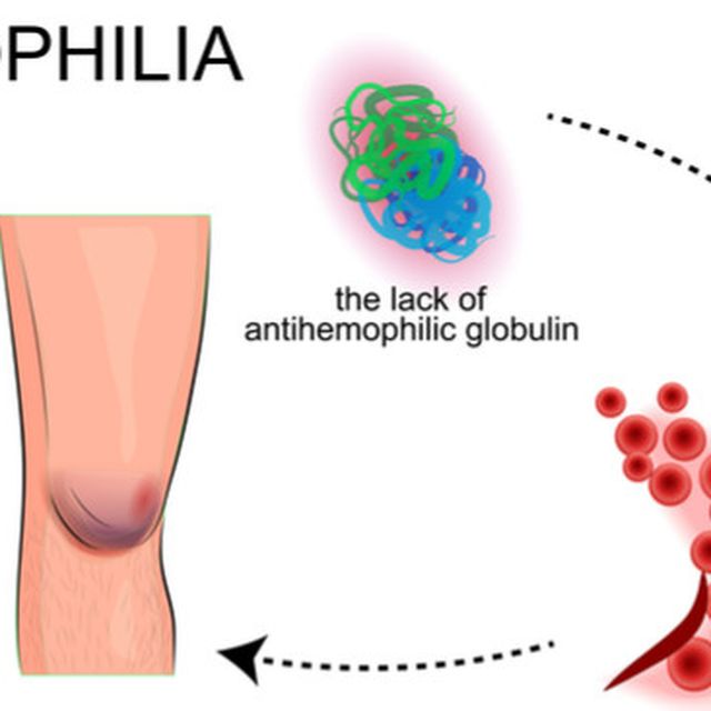 Detail Gambar Penyakit Hemofilia Nomer 14