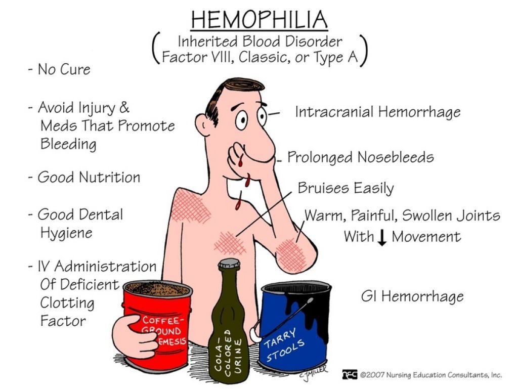 Detail Gambar Penyakit Hemofilia Nomer 37