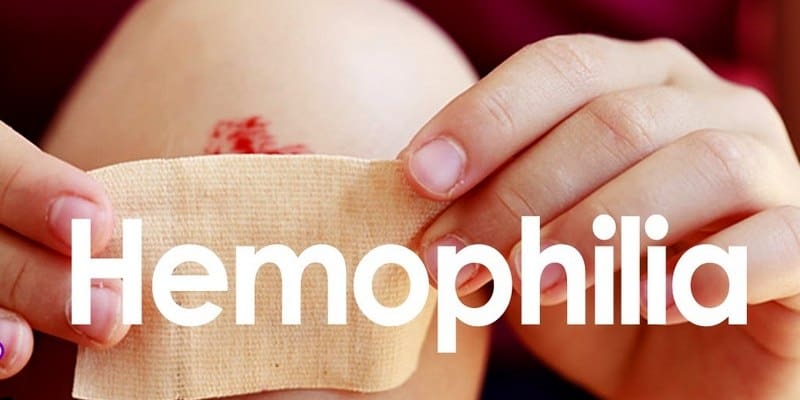 Detail Gambar Penyakit Hemofilia Nomer 41