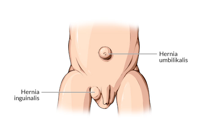 Detail Gambar Penyakit Hernia Nomer 2