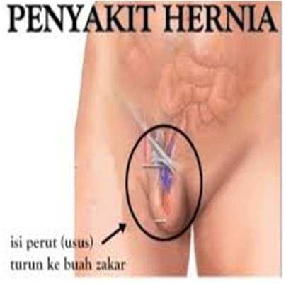 Detail Gambar Penyakit Hernia Nomer 12