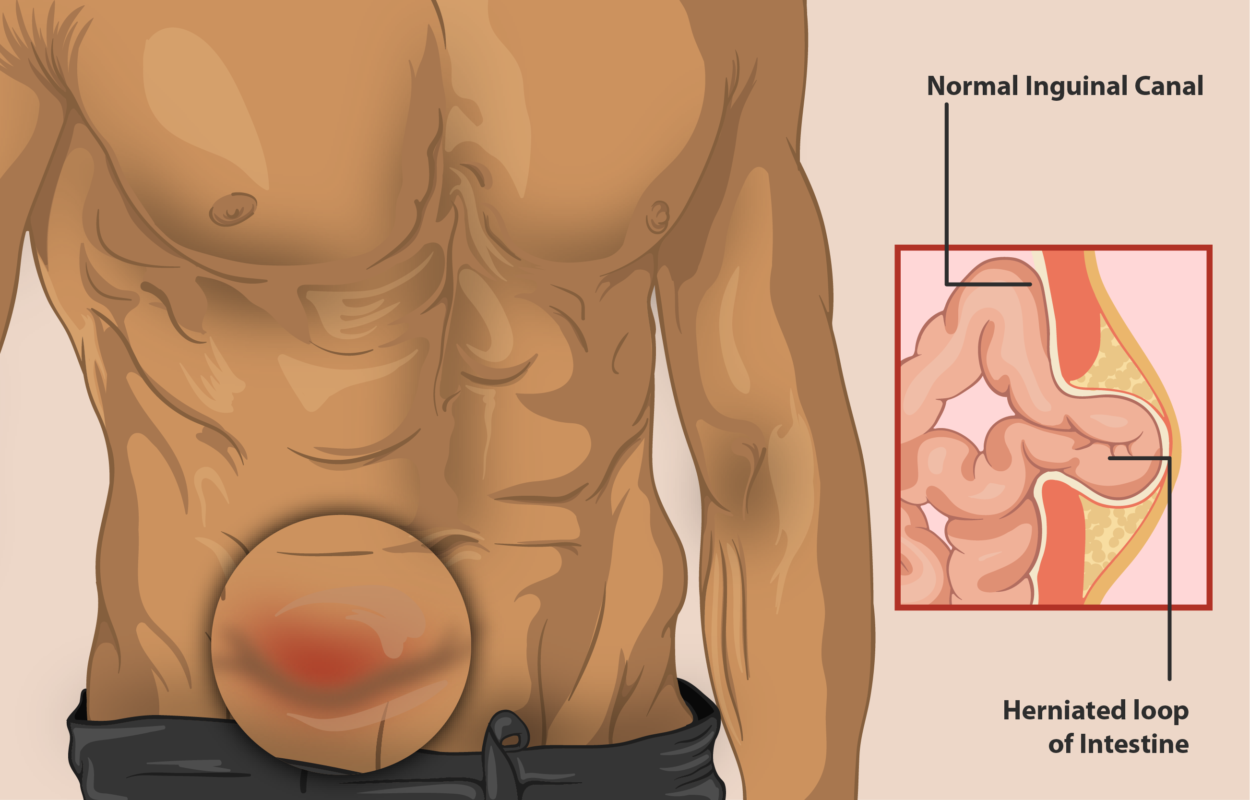 Detail Gambar Penyakit Hernia Nomer 17