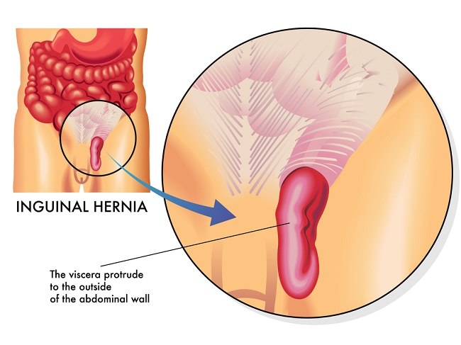 Detail Gambar Penyakit Hernia Nomer 21