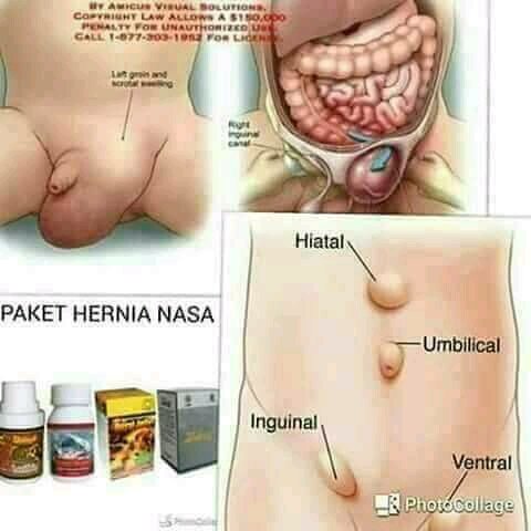 Detail Gambar Penyakit Hernia Nomer 24