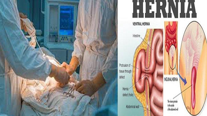 Detail Gambar Penyakit Hernia Nomer 26