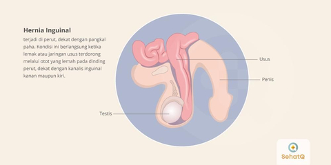 Detail Gambar Penyakit Hernia Nomer 4