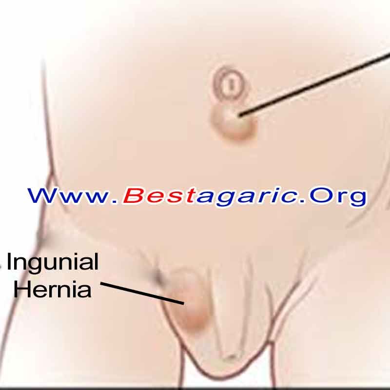 Detail Gambar Penyakit Hernia Nomer 36