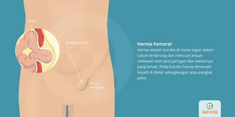 Detail Gambar Penyakit Hernia Nomer 49