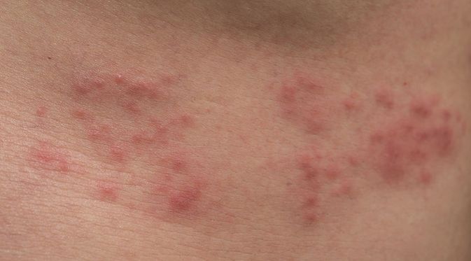 Detail Gambar Penyakit Herpes Nomer 13