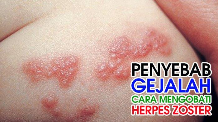 Detail Gambar Penyakit Herpes Nomer 14