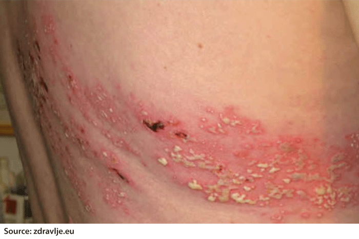Detail Gambar Penyakit Herpes Nomer 3