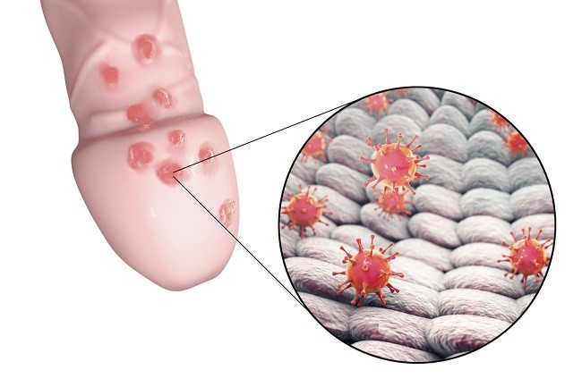 Detail Gambar Penyakit Herpes Nomer 27