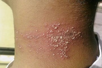 Detail Gambar Penyakit Herpes Nomer 9