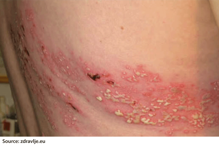 Detail Gambar Penyakit Herpes Pada Kulit Nomer 12