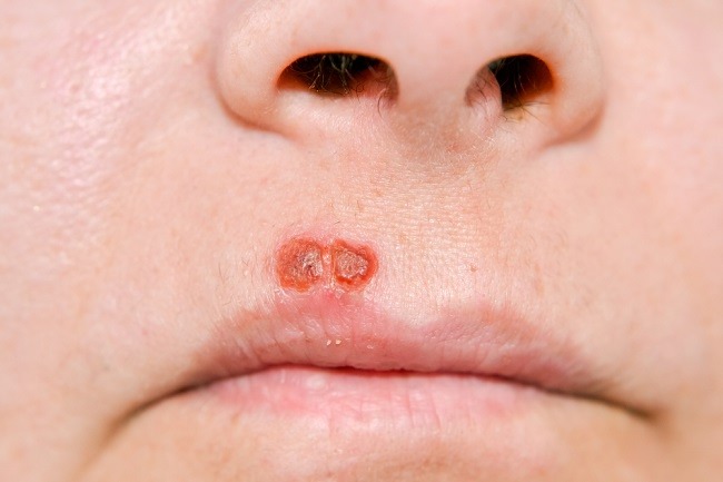 Detail Gambar Penyakit Herpes Pada Kulit Nomer 15