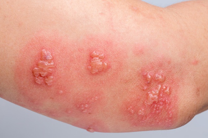 Detail Gambar Penyakit Herpes Pada Kulit Nomer 18