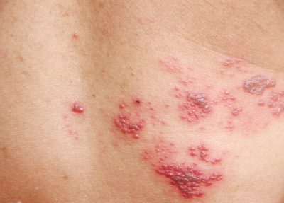 Detail Gambar Penyakit Herpes Pada Kulit Nomer 25