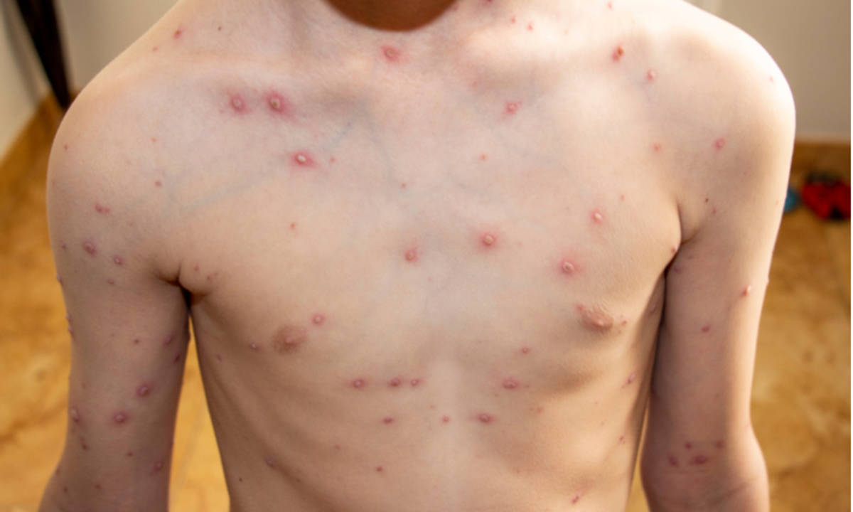Detail Gambar Penyakit Herpes Pada Kulit Nomer 35