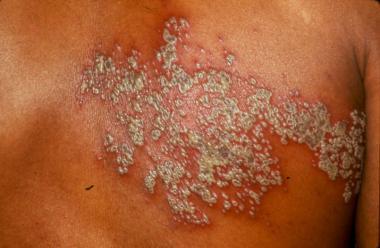 Detail Gambar Penyakit Herpes Pada Kulit Nomer 43