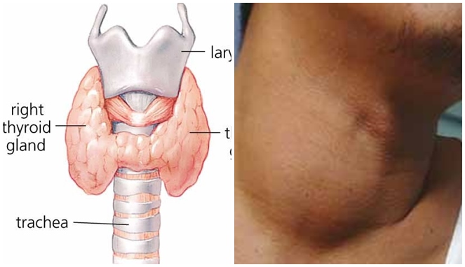 Detail Gambar Penyakit Hipertiroid Nomer 18