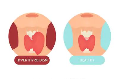 Detail Gambar Penyakit Hipertiroid Nomer 30