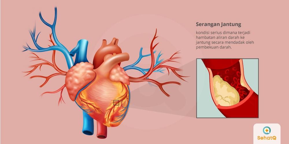 Detail Gambar Penyakit Jantung Nomer 2