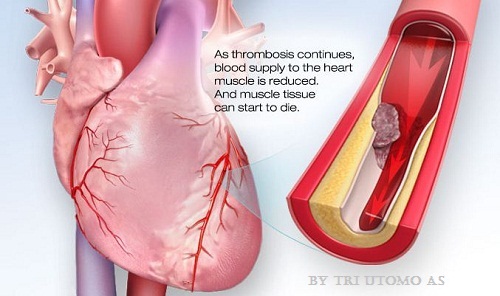 Detail Gambar Penyakit Jantung Nomer 32