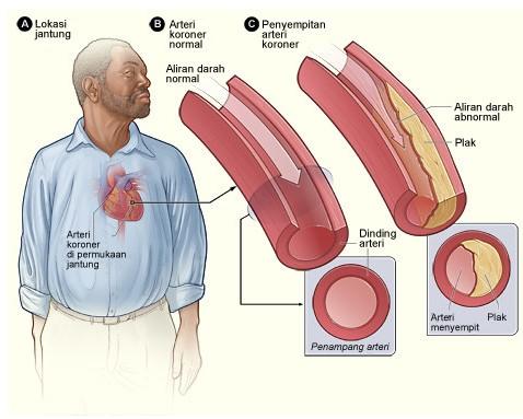 Detail Gambar Penyakit Jantung Koroner Nomer 17