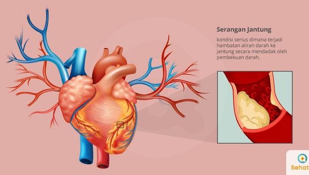 Detail Gambar Penyakit Jantung Koroner Nomer 39