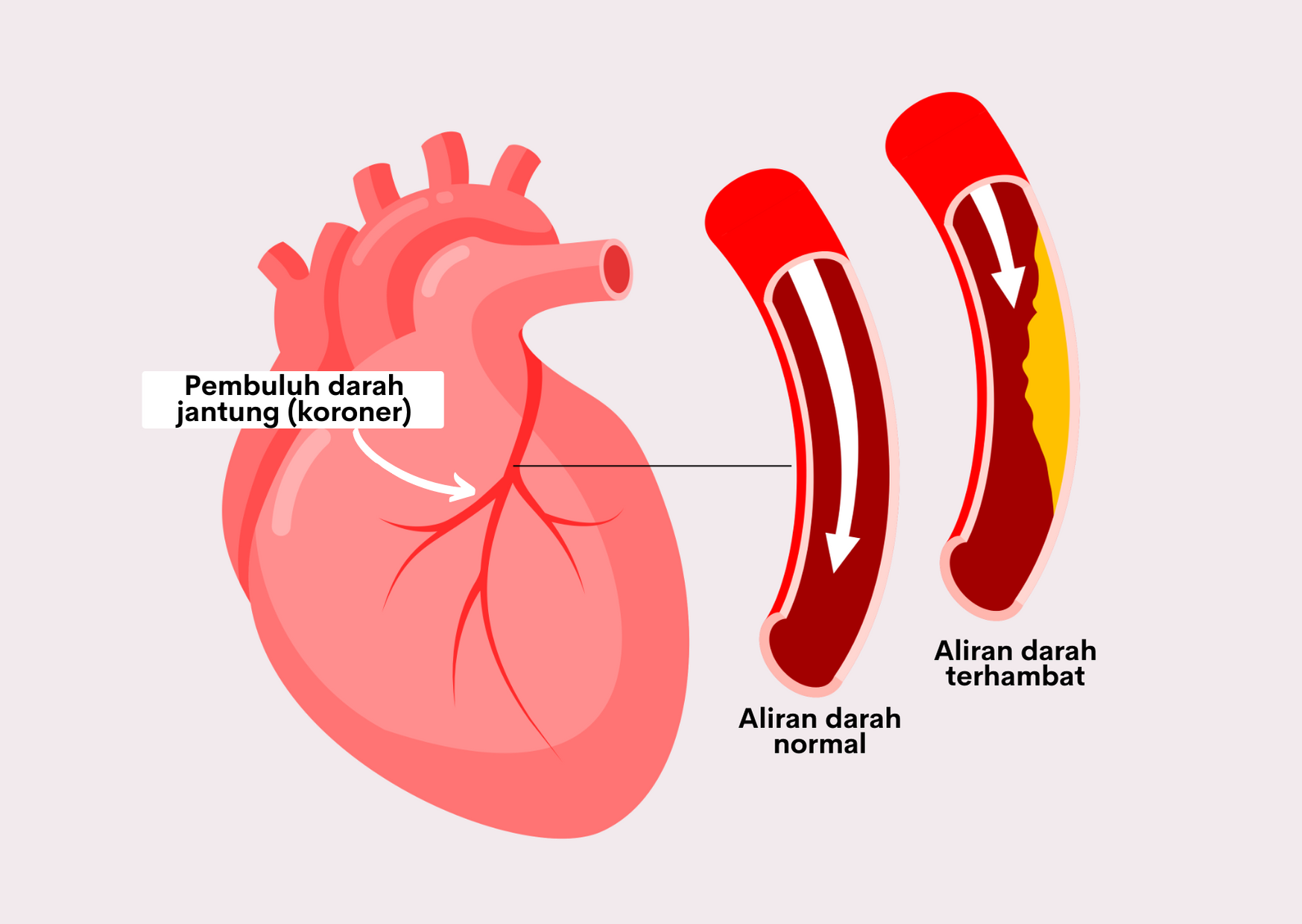 Detail Gambar Penyakit Jantung Koroner Nomer 5