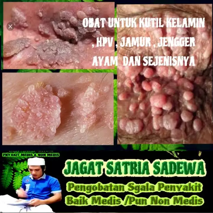 Detail Gambar Penyakit Jengger Ayam Nomer 13