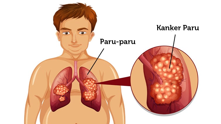 Detail Gambar Penyakit Kanker Paru Paru Nomer 16