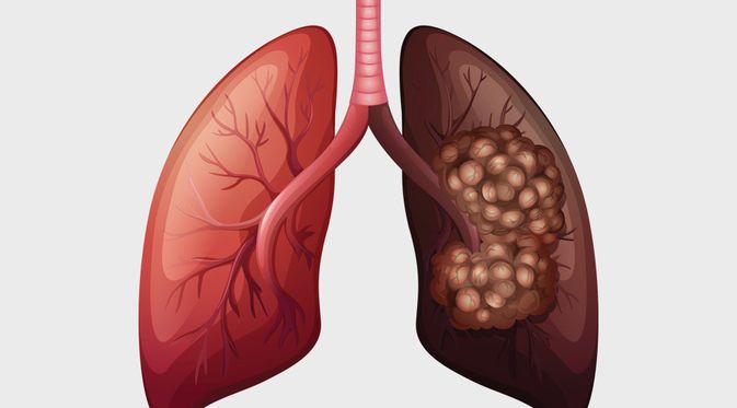 Detail Gambar Penyakit Kanker Paru Paru Nomer 3
