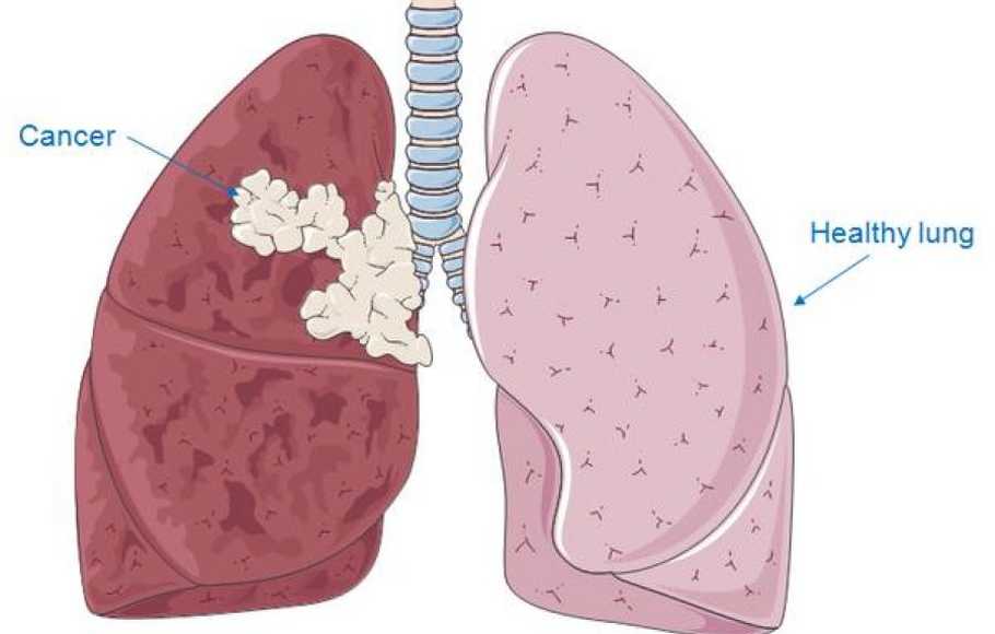 Detail Gambar Penyakit Kanker Paru Paru Nomer 17