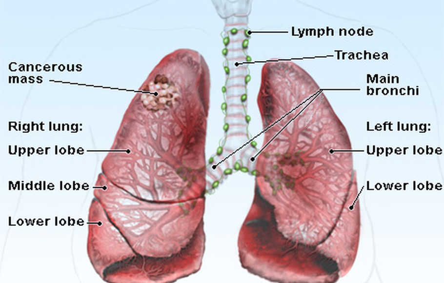 Detail Gambar Penyakit Kanker Paru Paru Nomer 22