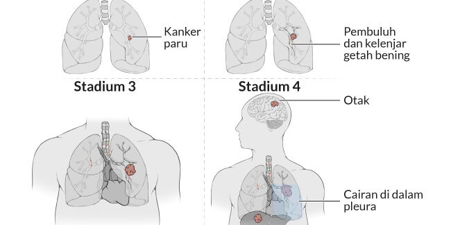 Detail Gambar Penyakit Kanker Paru Paru Nomer 26