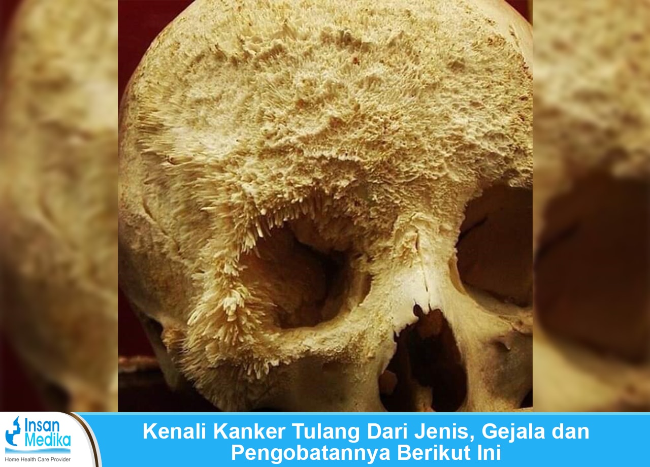 Detail Gambar Penyakit Kanker Tulang Nomer 16