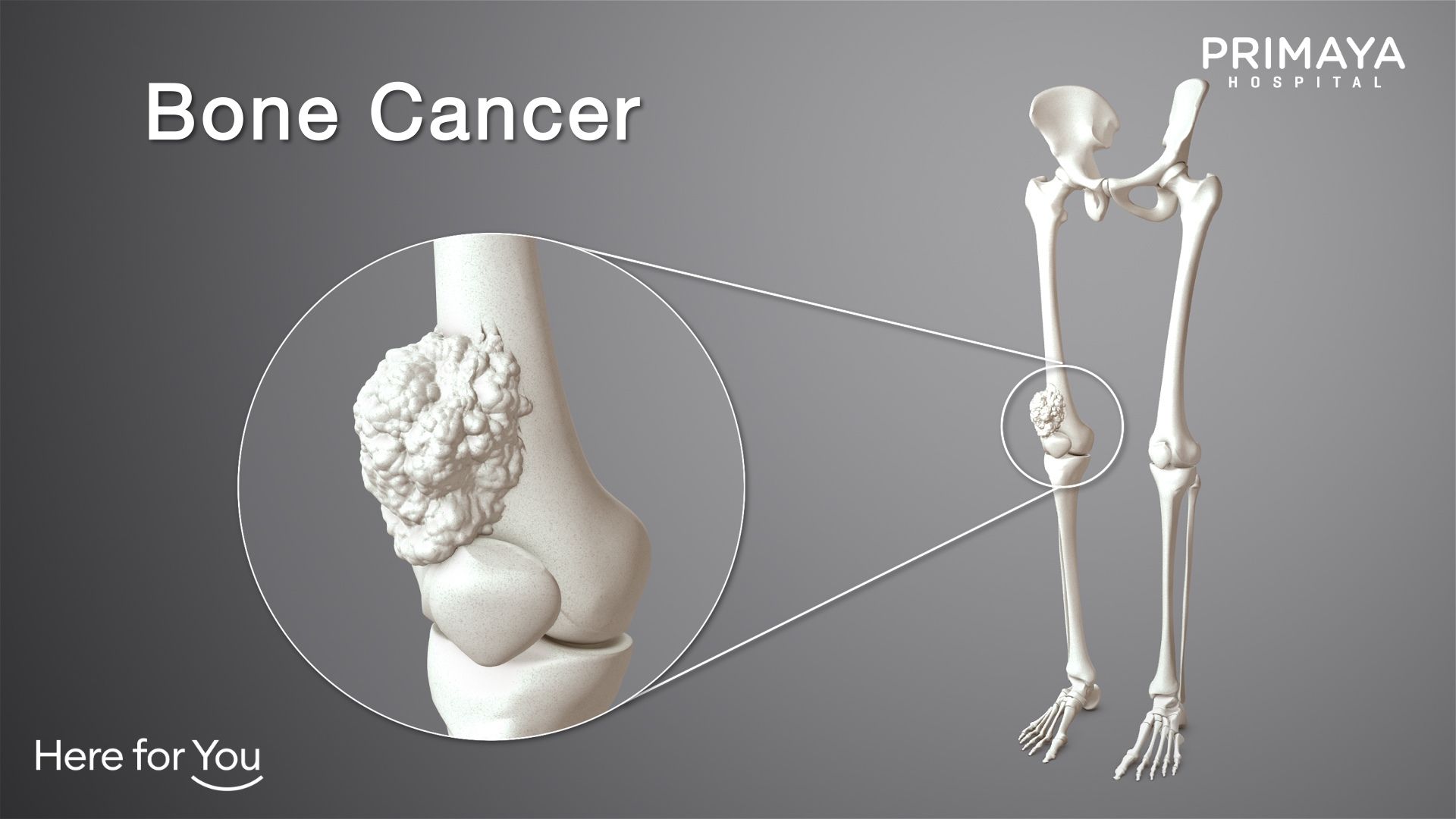 Detail Gambar Penyakit Kanker Tulang Nomer 4